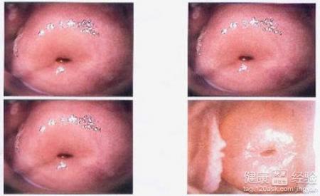 宫颈糜烂最新手术治疗，科技重塑女性健康之路